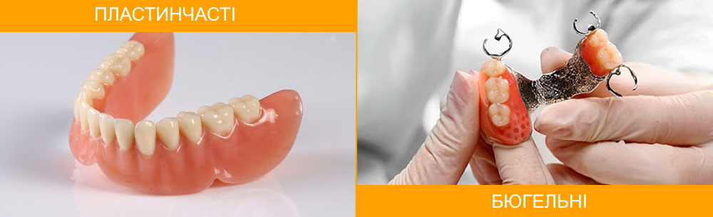 Отличие пластинчатых и бюгельных съемных зубных протезов
